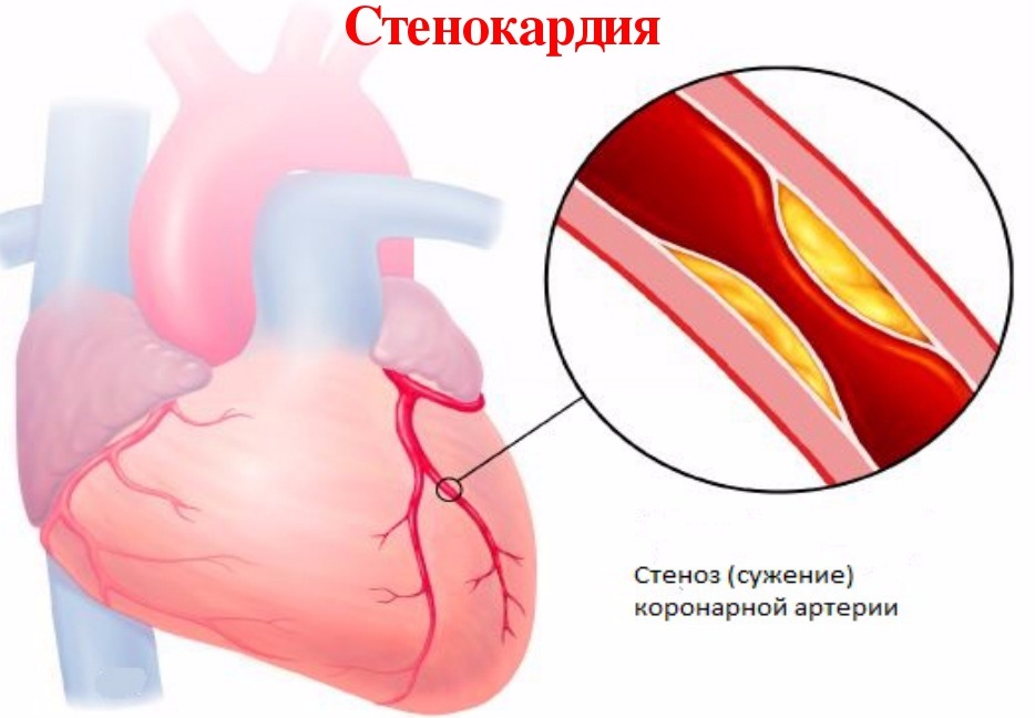 давящая боль в области сердца